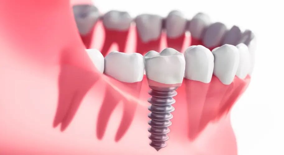 Procédure de pose d'implant dentaire – NURIDENT